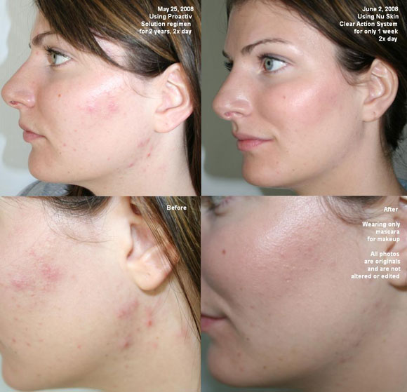 Примеры лечения акне с помощью Nu Skin Clear Action